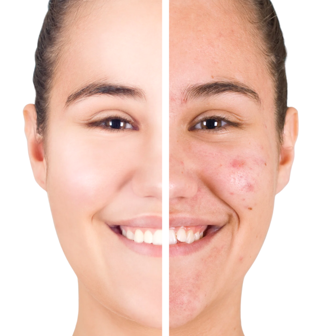 Organic Anti-Acne Nourishing Facial Wash - For WOMEN