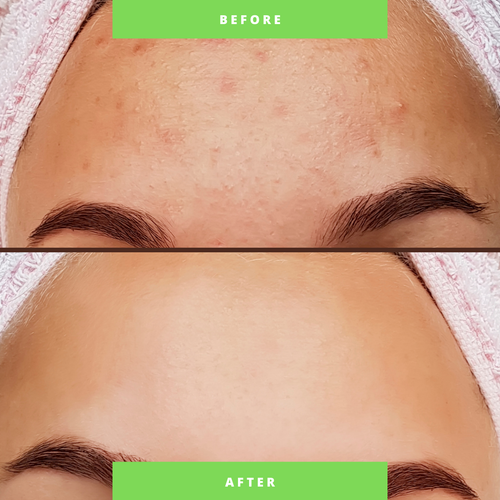 Anti-Acne Organic Three-Step System For Moderate/Severe Acne - For WOMEN